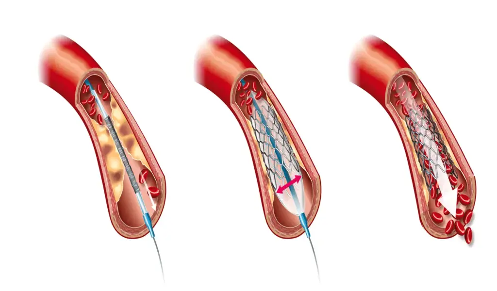 can a person travel after angioplasty