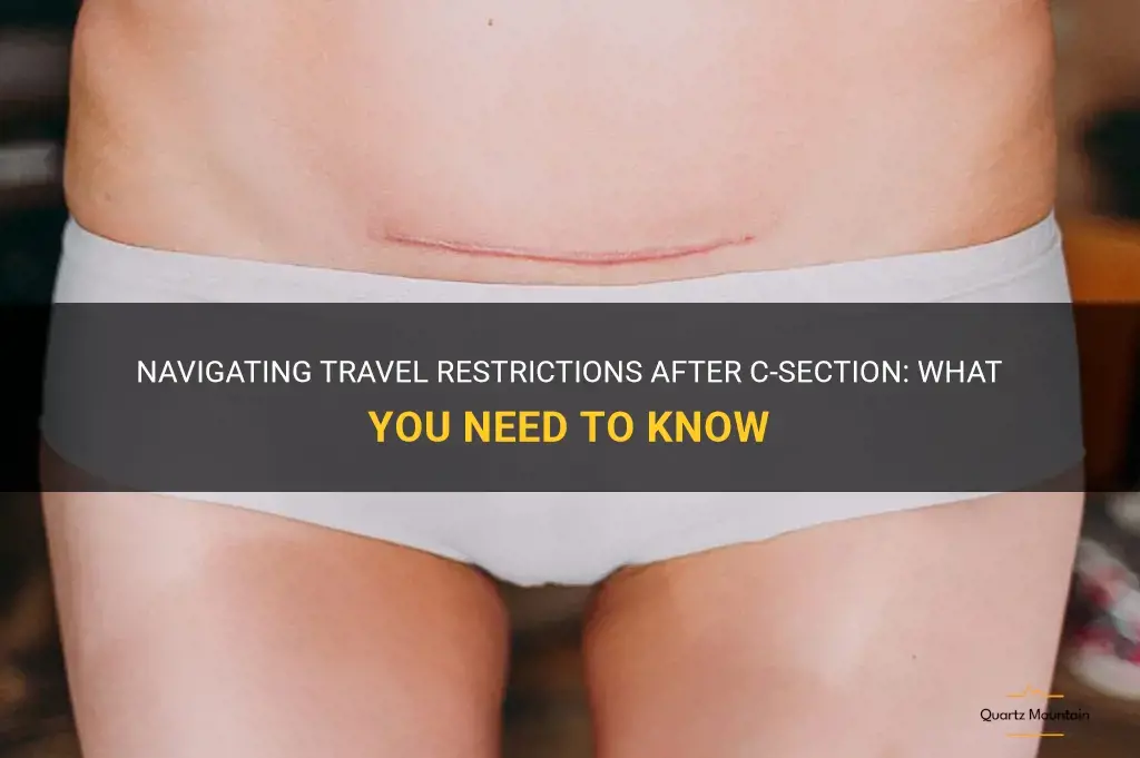c-section travel restrictions
