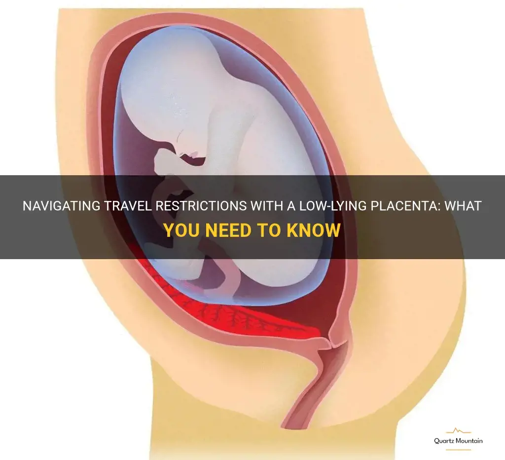 low lying placenta travel restrictions
