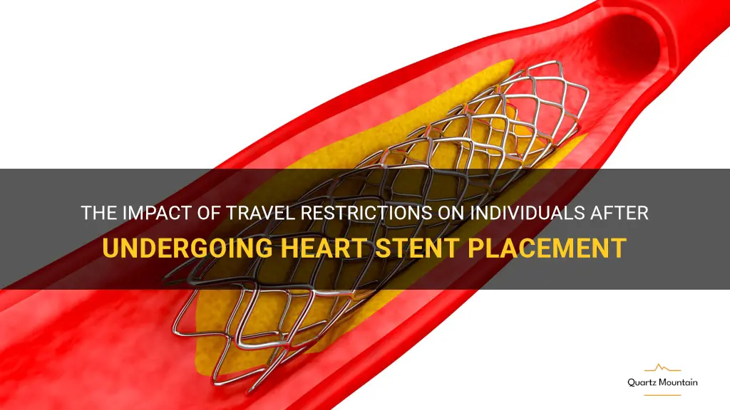 travel restrictions after getting a stent in your heart