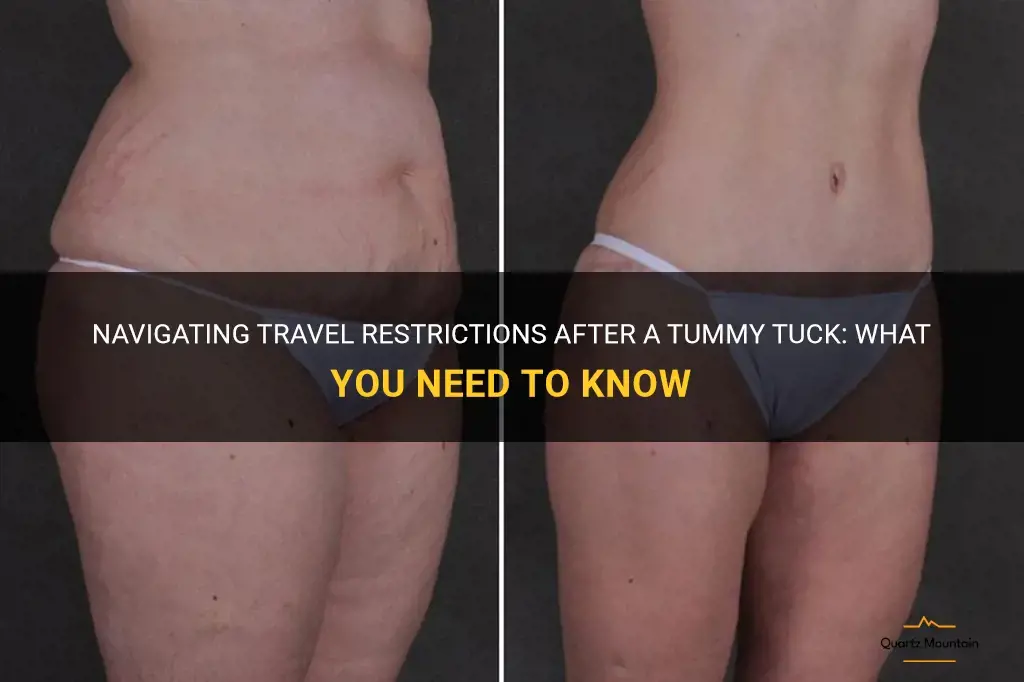 travel restrictions after tummy tuck