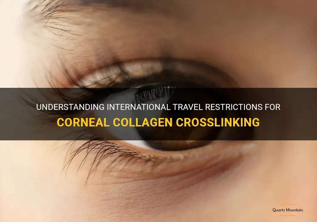 travel restrictions for corneal collagen crosslinking