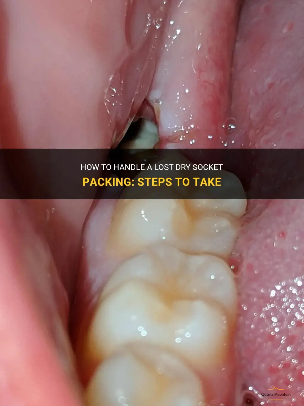 what to do if dry socket packing comes out