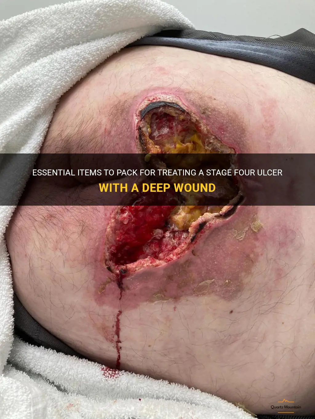 what to pack stage four ulcer deep wound with